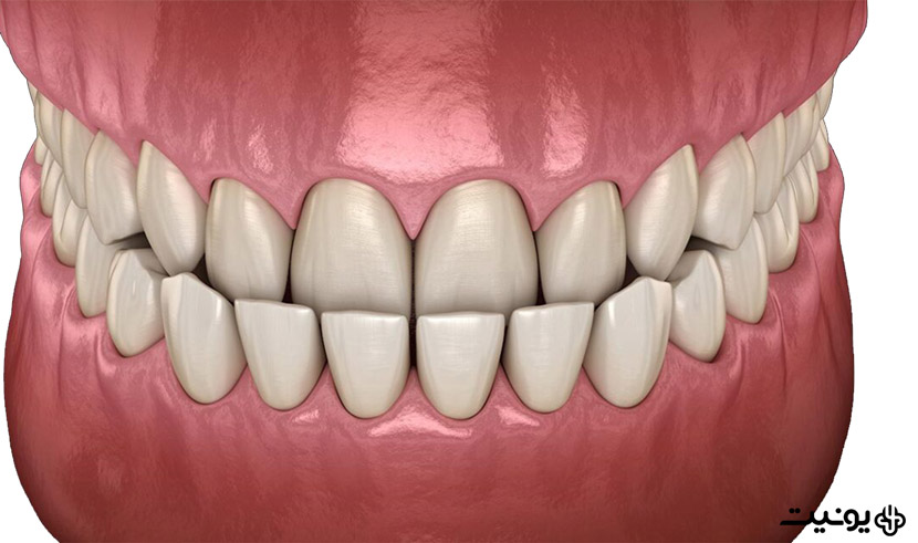 آندربایت دندانی چیست؟