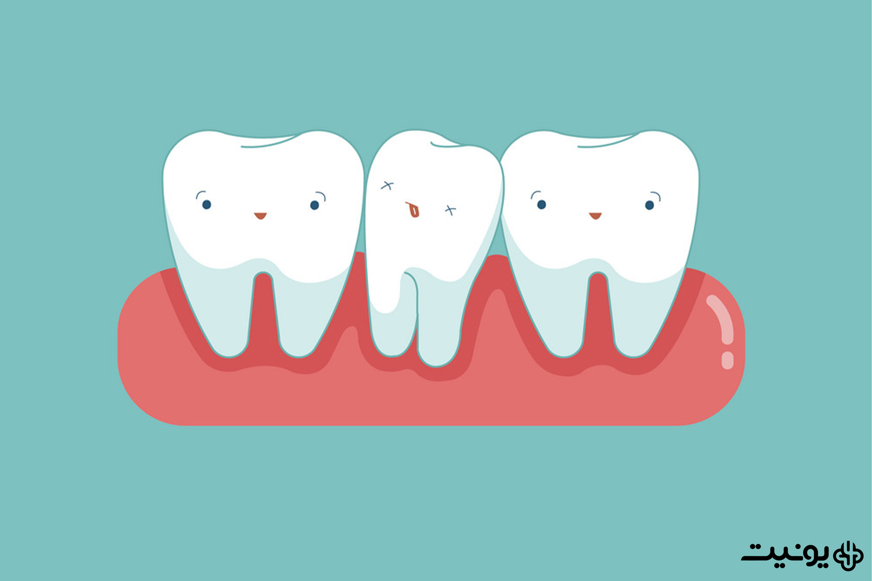 ازدحام دندانی یا crowding teeth