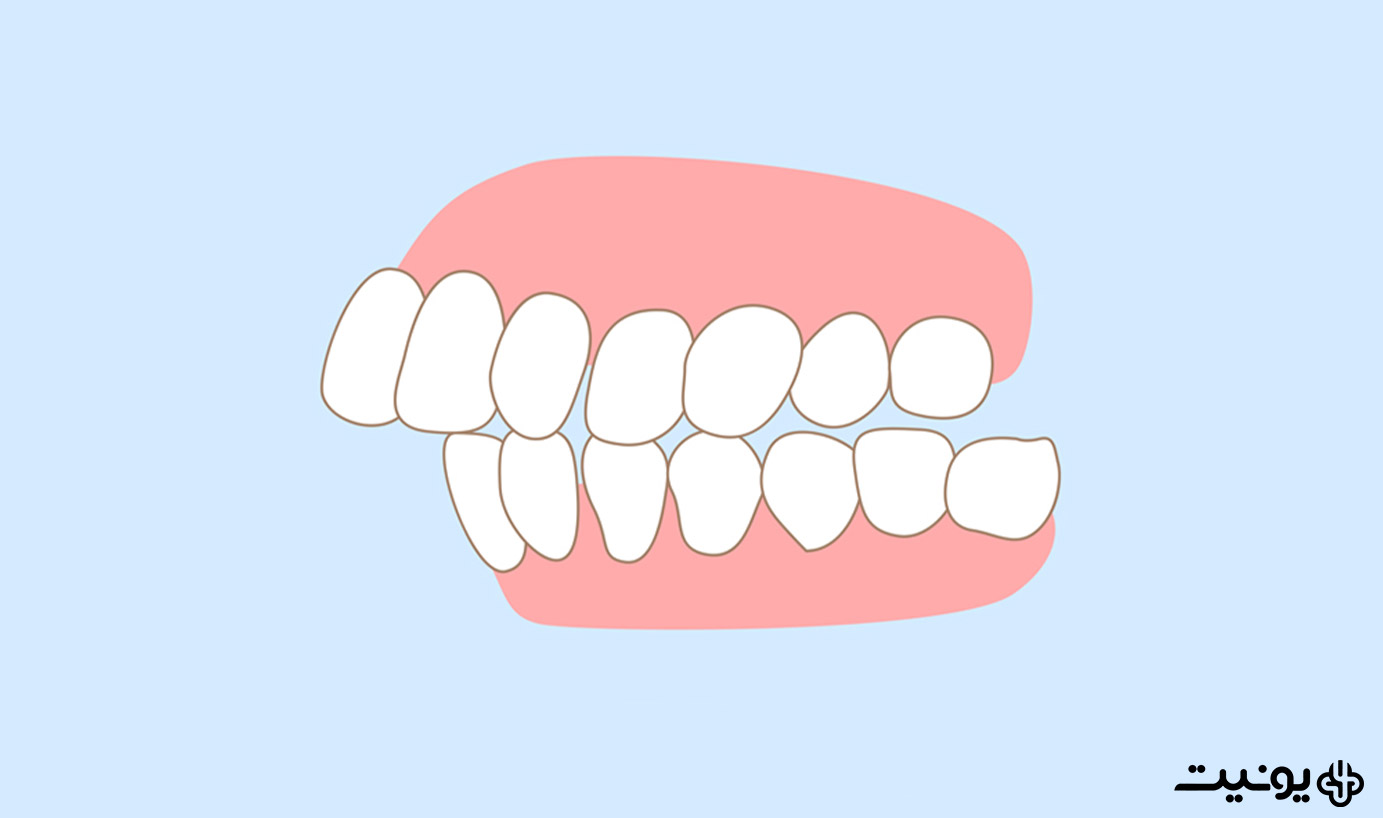 اورجت دندانی چیست؟