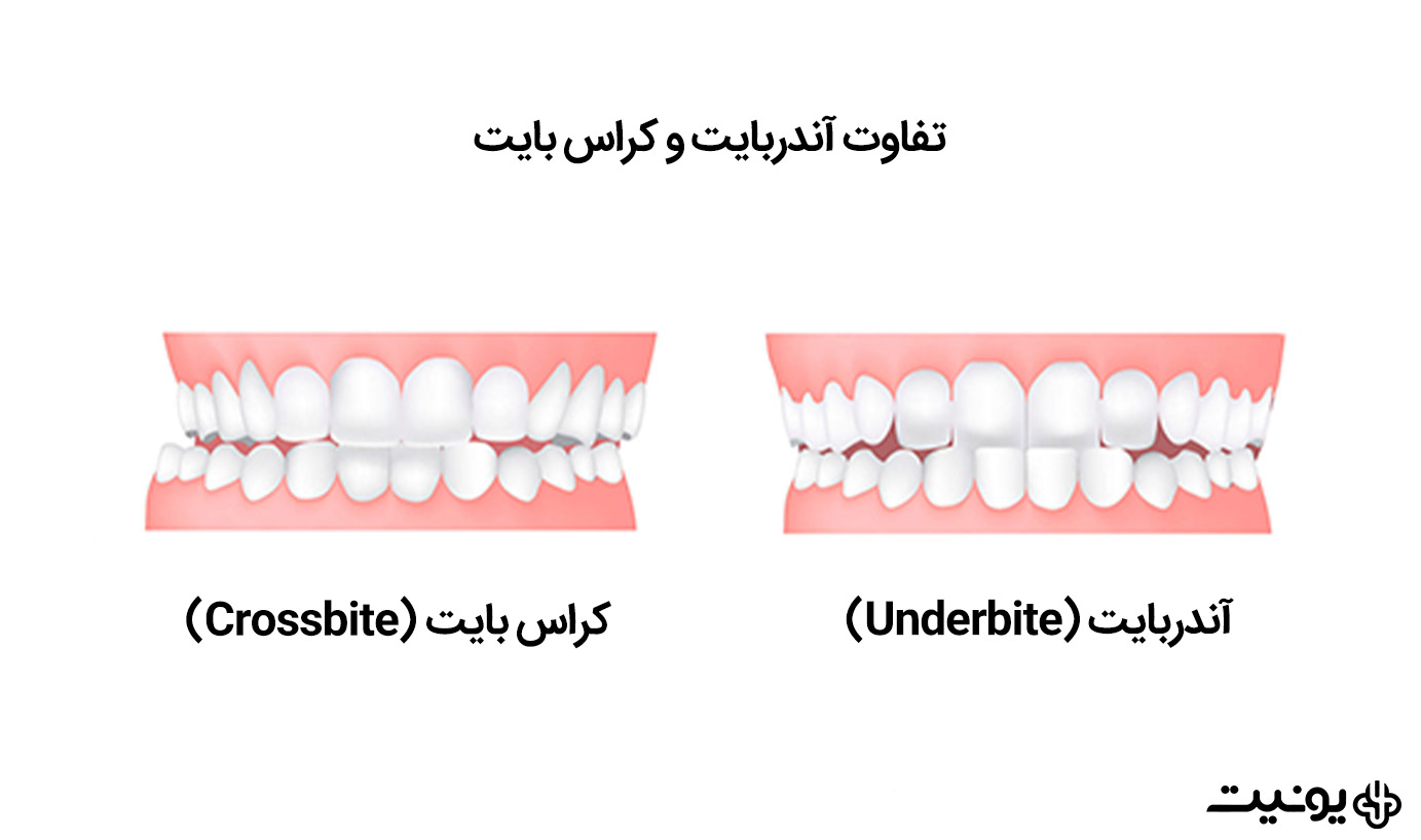 تفاوت کراس بایت و آندربایت دندانی