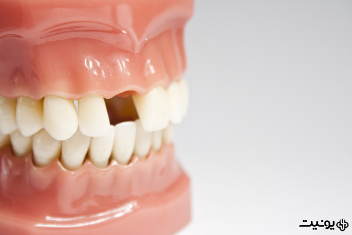 دندان غایب یا missing tooth چیست؟