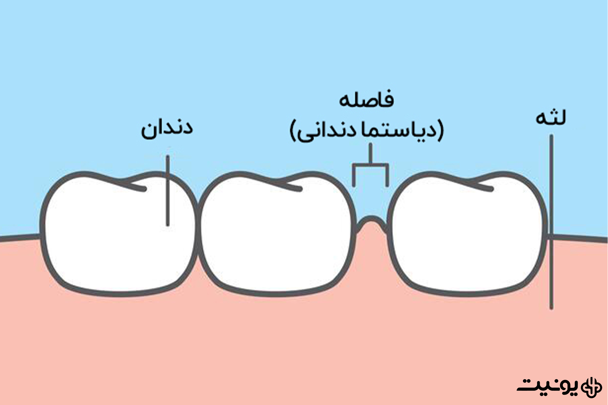 دیاستما یا فاصله بین دندانی چیست؟