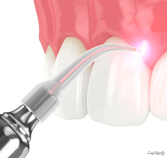 کاربرد تکنولوژی لیزر در دندانپزشکی