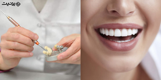 کامپوزیت پرسلین دندانپزشکی